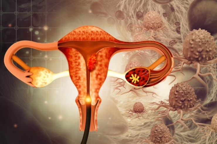 Intrauterine Insemination (IUI)